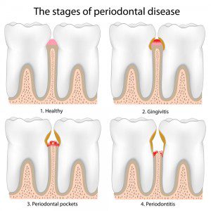 periodontial-disease-treatment-ventura