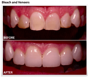 veneers-teeth-whitening