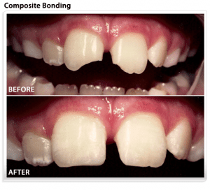 dental-composite-teeth-bonding