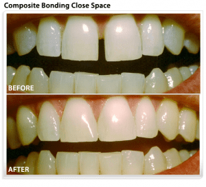 cosmetic-dental-bonding