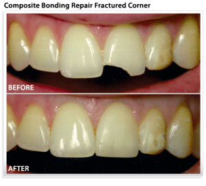 dental-bonding-tooth-fracture