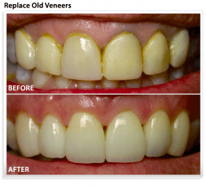 replace-veneers