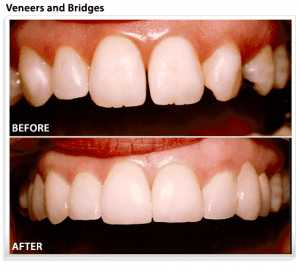 dental-bridge-veneers