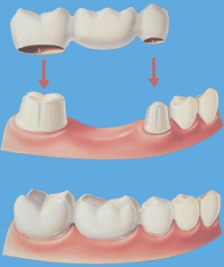 dental-bridges-ventura
