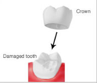 crown-dental-ca