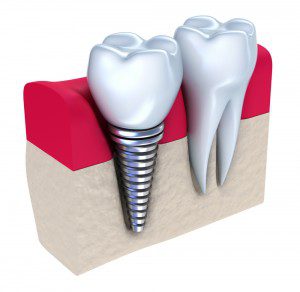 dental-implants-ventura-dentist