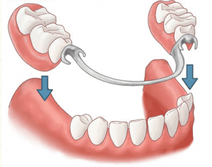 dentures trauma denture infection occasionally periodontal