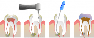 endodonic-therapy-ventura-ca