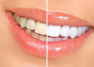 teeth-whitening-dentist-ventura