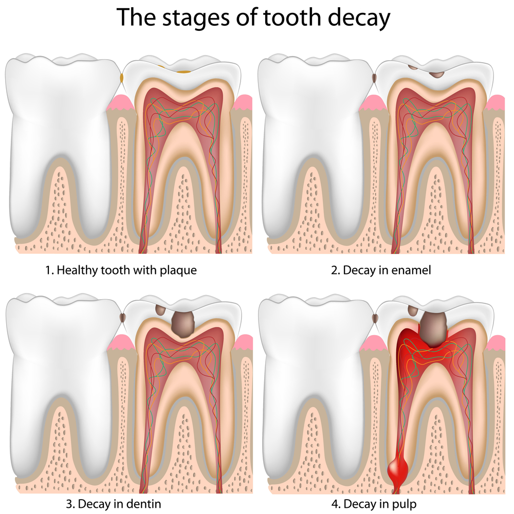 dental-fillings-dentist-ventura